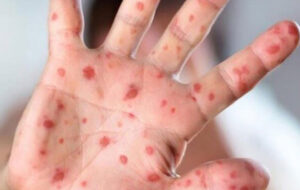 هشدار درباره افزایش موارد مشکوک به سرخک در دزفول