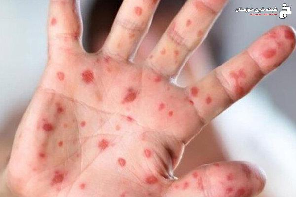 هشدار درباره افزایش موارد مشکوک به سرخک در دزفول هشدار درباره افزایش موارد مشکوک به سرخک در دزفول